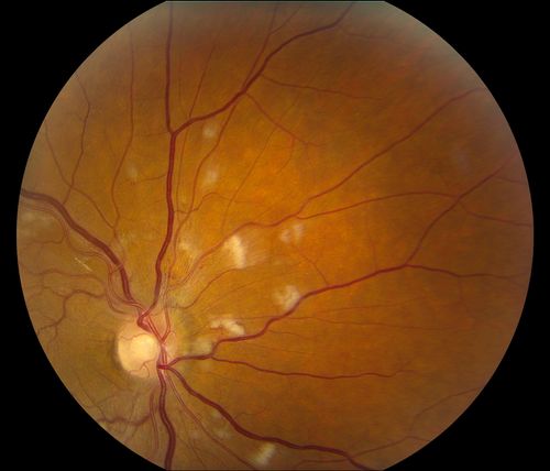 Hypertensive Retinopathy
Patient comes in complaining of spots in vision in both eyes. VA was 20/25 - right eye and 20/20- left eye. Fundus exam reveals little hemorrhages with cotton wool spots due to hypertension and anemia. 
