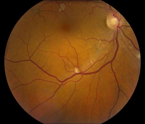 Hypertensive Retinopathy
Patient comes in complaining of spots in vision in both eyes. VA was 20/25 - right eye and 20/20- left eye. Fundus exam reveals little hemorrhages with cotton wool spots due to hypertension and anemia. 
