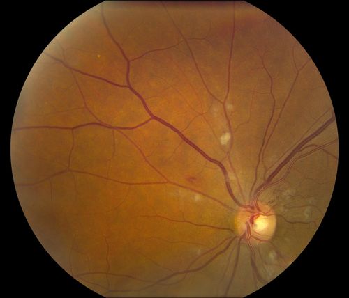 Hypertensive Retinopathy
Patient comes in complaining of spots in vision in both eyes. VA was 20/25 - right eye and 20/20- left eye. Fundus exam reveals little hemorrhages with cotton wool spots due to hypertension and anemia. 
