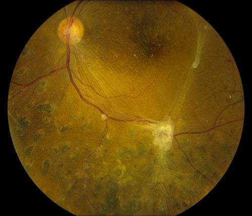 Post-Op Vitrectomy with Membrane Stripping and Laser
Patient had surgery to help clear up some vision in the left eye. Pre-op VA was count fingers at 1-ft. Post op VA was 20/200 in the left eye. Patient will return in 3-months for follow-up.
