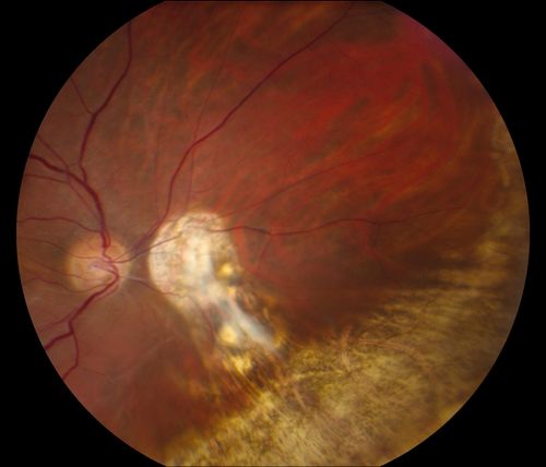 Reoccurring Retinal Detachment
Patient comes in for second opinion for RD in the right eye. Patient's VA was count fingers @ 2-ft in the right eye and 20/20 in the left eye. Patient is aphakic and has had 5- retinal surgeries in the past in the right eye including a scleral buckle. RD present with the macula off. Will consider surgery with silicone oil. 
