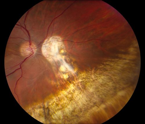 Reoccurring Retinal Detachment
Patient comes in for second opinion for RD in the right eye. Patient's VA was count fingers @ 2-ft in the right eye and 20/20 in the left eye. Patient is aphakic and has had 5- retinal surgeries in the past in the right eye including a scleral buckle. RD present with the macula off. Will consider surgery with silicone oil. 
