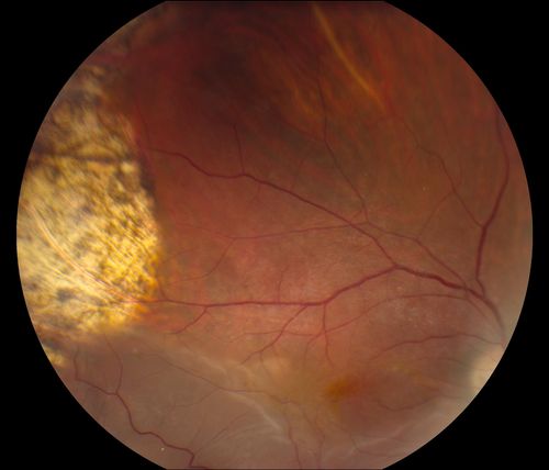 Reoccurring Retinal Detachment
Patient comes in for second opinion for RD in the right eye. Patient's VA was count fingers @ 2-ft in the right eye and 20/20 in the left eye. Patient is aphakic and has had 5- retinal surgeries in the past in the right eye including a scleral buckle. RD present with the macula off. Will consider surgery with silicone oil. 
