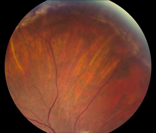 Reoccurring Retinal Detachment
Patient comes in for second opinion for RD in the right eye. Patient's VA was count fingers @ 2-ft in the right eye and 20/20 in the left eye. Patient is aphakic and has had 5- retinal surgeries in the past in the right eye including a scleral buckle. RD present with the macula off. Will consider surgery with silicone oil. 
