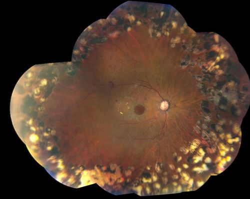 Macular Hole with Peripheral Laser Scars
Diabetic patient comes in with flashes and floaters in both eyes. Patient's VA is 20/400, right eye and 20/25, left eye. Fundus exam presents with large macular hole with diabetic changes in the retina. Laser scars in the peripheral. 
Keywords: may2013