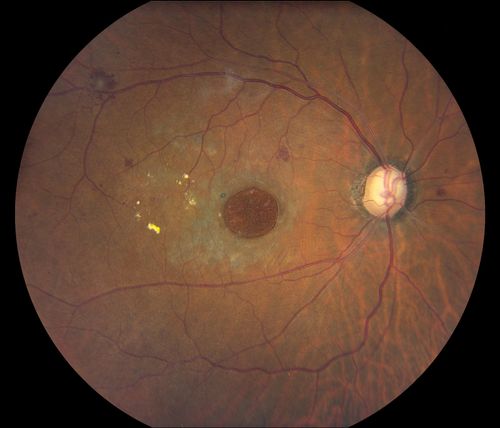 Macular Hole with Peripheral Laser Scars
Diabetic patient comes in with flashes and floaters in both eyes. Patient's VA is 20/400, right eye and 20/25, left eye. Fundus exam presents with large macular hole with diabetic changes in the retina. Laser scars in the peripheral. 
