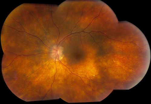 Patient comes in with 6-month follow up for uveitis. VA is 20/20, both eyes. RPE peripheral scarring and punched out lesions visible. Stable. Pred Forte as needed for flare ups.
