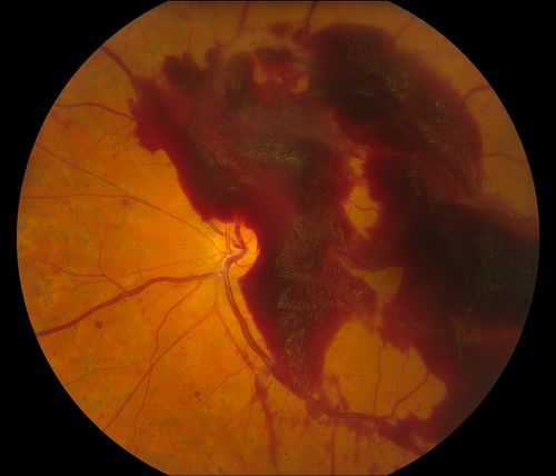 Macular Pre-Retinal Hemorrhage 
Patient complains of loss of vision in his left eye. Patient is diabetic. VA was 20/20, right eye and 20/150, left eye with no improvement pinhole. Fundus exam reveals very large pre retinal hemorrhage in the left eye. Embolism located inferior, nasally just off the optic nerve in the left eye. Patient underwent PRP for treatment of the hemorrhage.
