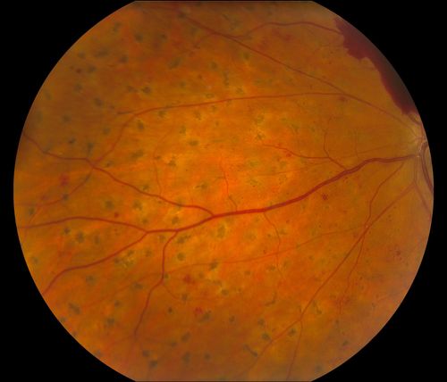 Macular Pre-Retinal Hemorrhage 
Patient complains of loss of vision in his left eye. Patient is diabetic. VA was 20/20, right eye and 20/150, left eye with no improvement pinhole. Fundus exam reveals very large pre retinal hemorrhage in the left eye. Embolism located inferior, nasally just off the optic nerve in the left eye. Patient underwent PRP for treatment of the hemorrhage.
