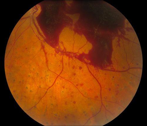 Macular Pre-Retinal Hemorrhage 
Patient complains of loss of vision in his left eye. Patient is diabetic. VA was 20/20, right eye and 20/150, left eye with no improvement pinhole. Fundus exam reveals very large pre retinal hemorrhage in the left eye. Embolism located inferior, nasally just off the optic nerve in the left eye. Patient underwent PRP for treatment of the hemorrhage.
