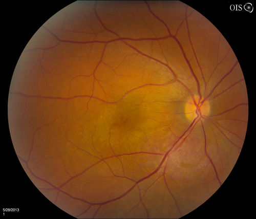 Cavernous Choroidal Hemangioma
Patient presents with Cavernous Choroidal Hemangioma in the right eye. VA is 20/50 after manifest refraction. Patient also notices decreased vision with shadow close to her central vision in the right eye. Patient will undergo photodynamic therapy in the right eye. 
