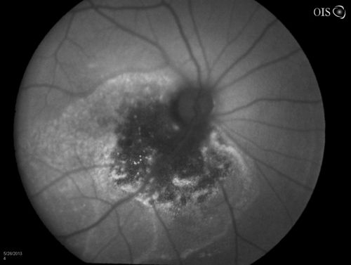 Cavernous Choroidal Hemangioma
Patient presents with Cavernous Choroidal Hemangioma in the right eye. VA is 20/50 after manifest refraction. Patient also notices decreased vision with shadow close to her central vision in the right eye. Patient will undergo photodynamic therapy in the right eye. 
