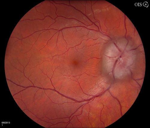 Papilledema Probable to Pseudo-tumor Cerebri
A 24-year old female who presents severe headaches and vision loss over the past 6-months. VA was 20/40 with pinhole 20/25, right eye and 20/25, left eye. Fundiscopic exam reveals 3-4 plus papilledema of both optic nerves. Patient has VF defects inferior, nasal-right eye and enlarged blind spot with an inferior arcuate defect present. Patient will get MRI and work-up with treatment in the hospital. 
