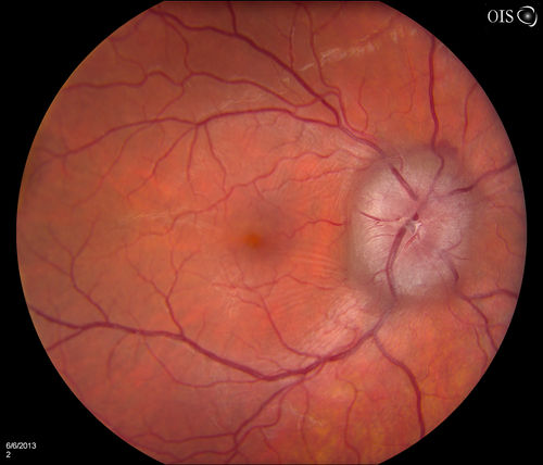 Papilledema Probable to Pseudo-tumor Cerebri
A 24-year old female who presents severe headaches and vision loss over the past 6-months. VA was 20/40 with pinhole 20/25, right eye and 20/25, left eye. Fundiscopic exam reveals 3-4 plus papilledema of both optic nerves. Patient has VF defects inferior, nasal-right eye and enlarged blind spot with an inferior arcuate defect present. Patient will get MRI and work-up with treatment in the hospital. 
