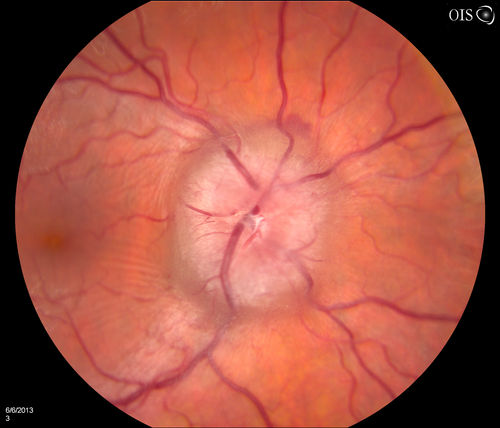 Papilledema Probable to Pseudo-tumor Cerebri
A 24-year old female who presents severe headaches and vision loss over the past 6-months. VA was 20/40 with pinhole 20/25, right eye and 20/25, left eye. Fundiscopic exam reveals 3-4 plus papilledema of both optic nerves. Patient has VF defects inferior, nasal-right eye and enlarged blind spot with an inferior arcuate defect present. Patient will get MRI and work-up with treatment in the hospital. 
