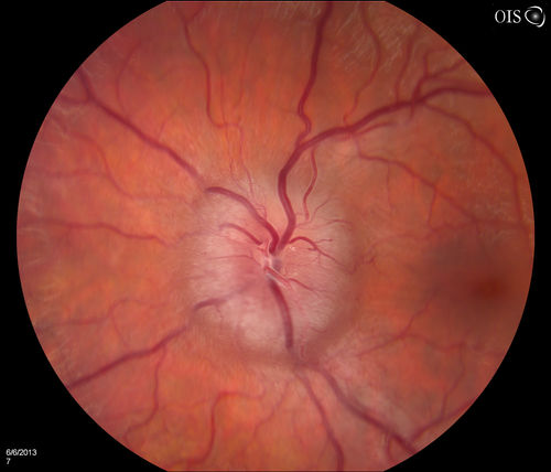 Papilledema Probable to Pseudo-tumor Cerebri
A 24-year old female who presents severe headaches and vision loss over the past 6-months. VA was 20/40 with pinhole 20/25, right eye and 20/25, left eye. Fundiscopic exam reveals 3-4 plus papilledema of both optic nerves. Patient has VF defects inferior, nasal-right eye and enlarged blind spot with an inferior arcuate defect present. Patient will get MRI and work-up with treatment in the hospital. 
