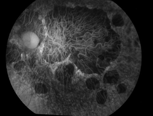 Central Areolar Choroidal Dystrophy
Patient wanted second opinion for atrophic macular degeneration. VA is 20/400, right eye and 20/100. left eye. Patient has very poor vision and also hearing impaired. Fundiscopic exam reveals very atrophy in the macula. FAF shows a central hole to the choroid with no neovascularization present. 
