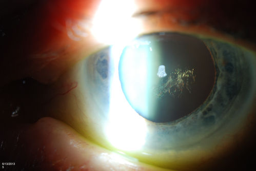 Polychromatic Cataract (Christmas Tree Cataract)
Patient comes in with cataract evaluation. Blurred vision in the left eye. Patient will think about surgery and call back to schedule.
