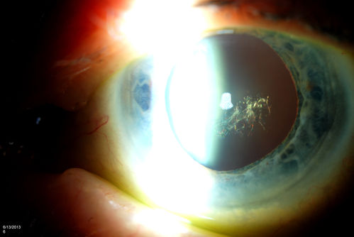 Polychromatic Cataract (Christmas Tree Cataract)
Patient comes in with cataract evaluation. Blurred vision in the left eye. Patient will think about surgery and call back to schedule.
