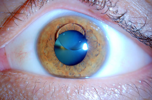 Silicone Oil in the Anterior Chamber
Patient comes in for second opinion for retinal detachment in the left eye. VA is hand motion in the left eye. Poor view to look into the retina. Small silicone bubble at 12 o'clock superior in the anterior chamber. Surgery was not recommended due to the silicone oil in the left eye. 
