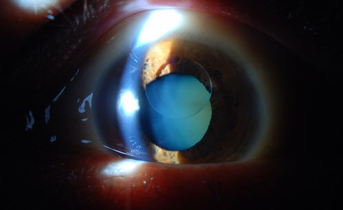 Silicone Oil in the Anterior Chamber
Patient comes in for second opinion for retinal detachment in the left eye. VA is hand motion in the left eye. Poor view to look into the retina. Small silicone bubble at 12 o'clock superior in the anterior chamber. Surgery was not recommended due to the silicone oil in the left eye. 
