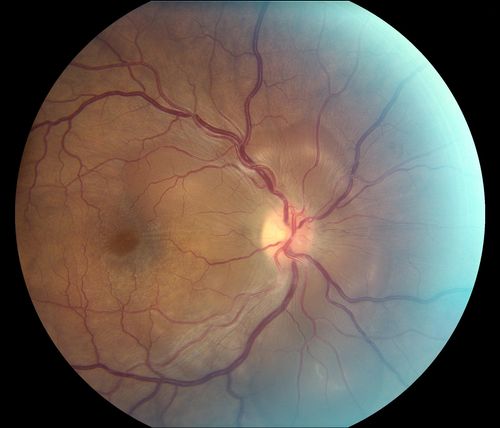 Optic Neuritis with Suspected Harada's Disease 
Young female patient comes in with red and irritated eyes which were sensitive to the touch. Patient also had vision loss in both eyes. VA was 20/80, right eye, 20/60, left eye. Fundiscopic exam shows sub retinal fluid in the right eye surrounding the optic nerve. Patient will start steroid therapy to reduce any other inflammation that is active.
