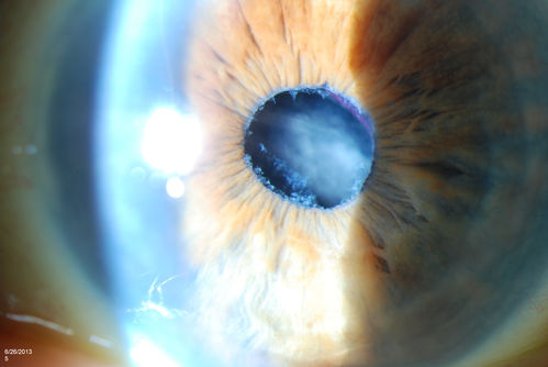 Pseudoexfoliation with Partial Subluxation
81-year old female who woke up with loss of vision in the left eye. Patient was hand motion in the left eye. Slit lamp examination shows dislocated lens with pseudoexfoliation material around the iris rim. Proceeded with cataract surgery.
