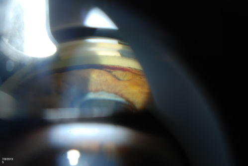 Gonioscopy of Blood in the Angle
Young female who has a history of uveitis, glaucoma and juvenile rheumatoid arthritis. VA is hand motion in the left eye. Pigment changes with some blood in the anterior chamber seen here on Gonioscopy. 
