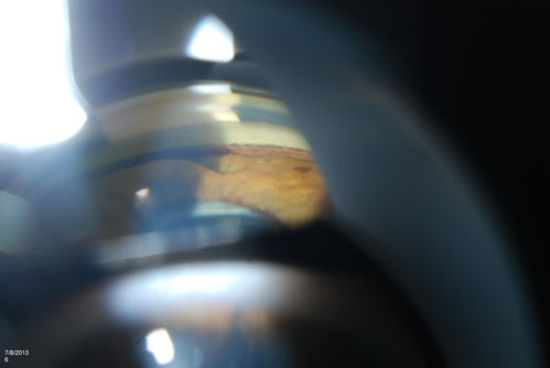 Gonioscopy of Blood in the Angle
Young female who has a history of uveitis, glaucoma and juvenile rheumatoid arthritis. VA is hand motion in the left eye. Pigment changes with some blood in the anterior chamber seen here on Gonioscopy. 

