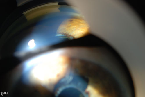 Gonioscopy of Blood in the Angle
Young female who has a history of uveitis, glaucoma and juvenile rheumatoid arthritis. VA is hand motion in the left eye. Pigment changes with some blood in the anterior chamber seen here on Gonioscopy. 
