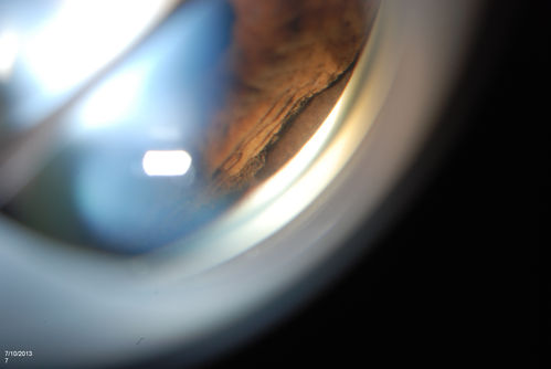 Ciliary Body Melanoma
71-year old male who was recently diagnosed with a large ciliary body melanoma that is pushing into the anterior chamber of the left eye. Patient is going to proceed with proton therapy. 
