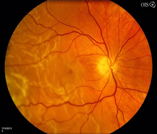 Retinal Detachment with Macula Detached.
Patient went to the ER over the weekend with loss of vision in the right eye. VA was count fingers in the right eye. Noticed a curtain in the right eye. Horseshoe tear was seen at 10-o'clock temporally, right eye. Proceeded with surgery the next day.
Keywords: july2013