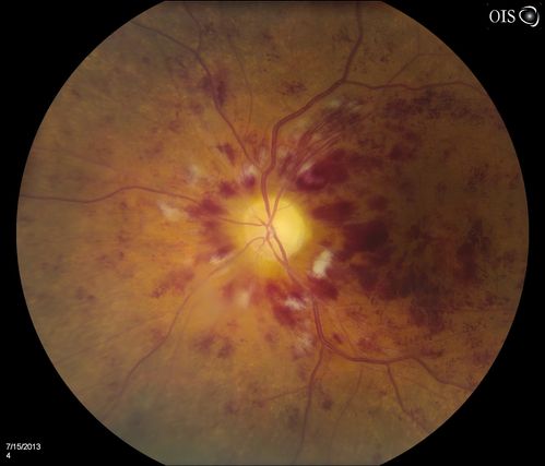 CRVO, Left Eye
Patient comes in with central retinal vein occlusion in the left eye. VA was count fingers in the left eye. Fundus photo shows scattered hemorrhages with cotton wool spots. Patient was treated with Avastin in the left eye.
