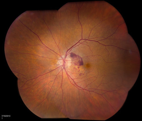 Macular Degeneration with Hemorrhage
Patient comes in with active leaking of AMD in the left eye. VA is 20/40 in the left eye. Patient was treated with Eylea and will return in 1-month for follow up.
