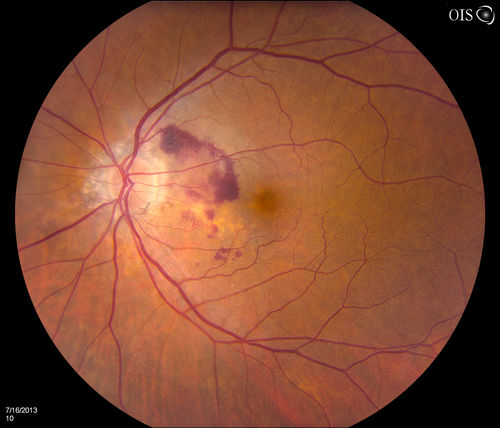 Macular Degeneration with Hemorrhage
Patient comes in with active leaking of AMD in the left eye. VA is 20/40 in the left eye. Patient was treated with Eylea and will return in 1-month for follow up.
