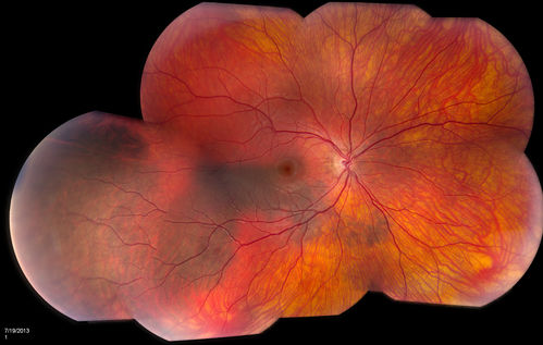 Large Choroidal Nevus
Young male patient who comes in for follow up on choroidal nevus in the right eye. VA is 20/30 in the right eye. Fundus montage photo shows very large nevus branched out from the macula to the temporal aspect of the right eye. Patient will be followed up in 3-months.
