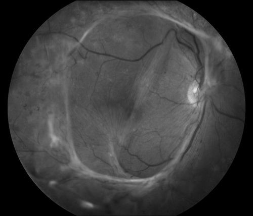 Fibrosis Traction
Young female patient with severe diabetes. Patients VA is 20/400 in the right eye. Fundus photos show a lot of fibrosis traction throughout the macula area. Fovea seems flat. Patient will undergo surgery for peeling of traction. 
