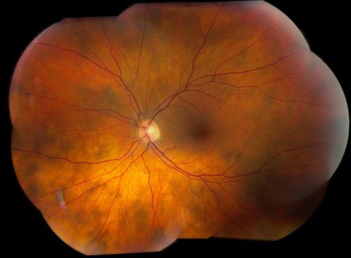 Multiple Uveal Choroidal Nevi
Patient referred for CHRPE which in this case has unusual appearance. VA is 20/20 in the both eyes. Distinguishing if there was any relation to polyposis. This is not CHRPE.
