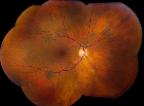 Multiple Uveal Choroidal Nevi
Patient referred for CHRPE which in this case has unusual appearance. VA is 20/20 in the both eyes. Distinguishing if there was any relation to polyposis. This is not CHRPE.
