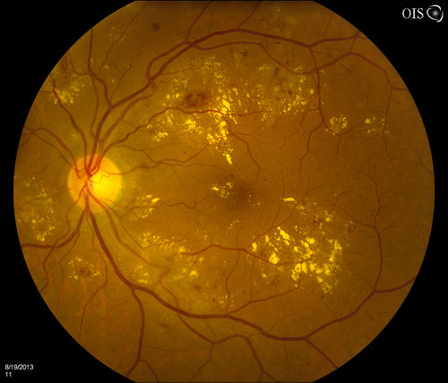 Background Diabetic Retinopathy
Patient with diabetes for over 11-years comes in with blurred vision. Blood sugar control is very poor. VA 20/50- right eye, 20/25-left eye. Fundus exam shows hard exudates with Circinate Rings and edema. Micro-aneurysms and retinal hemorrhage are present in both eyes. Patient will come back for laser treatment. 
