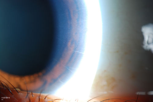 Prominent Corneal Nerves
Slit lamp exam shows prominent corneal nerves present at 8-10-o'clock and 4-6-o'clock. Baseline work to rule out Fuch's dystrophy and recurrent corneal erosion.

