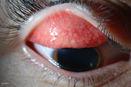 Giant Papillary Conjunctivitis
Patient wears soft contact lenses complained of irritation when the SCL would move. Inverted eyelid in both eyes and there was papillary +2 underneath the eyelid. 
Keywords: december2013