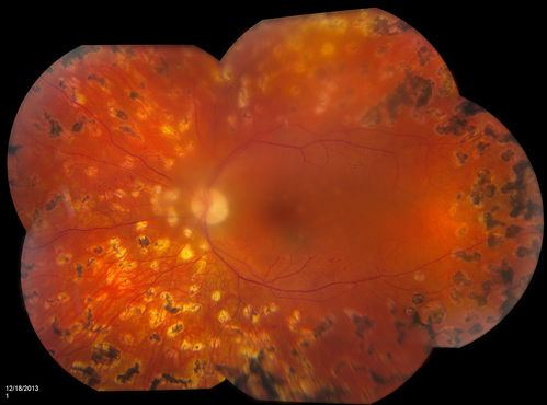 Diabetic Retinopathy with CME
Second opinion for diabetic retinopathy. VA is 20/30, right eye, 20/50, left eye. Patient has mild swelling in the macula of the right eye. No evidence of CME but does have a moderate cataract in the left eye. 
