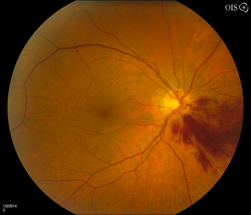 Branch Retinal Vein Occlusion
Patient's VA was 20/40, right eye. Fundus exam shows branch retinal vein occlusion nasally to the optic nerve in the right eye. 
