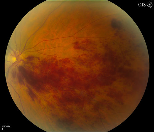 Branch Retinal Vein Occlusion
Patient's VA was 20/40, right eye. Fundus exam shows branch retinal vein occlusion nasally to the optic nerve in the right eye. 

