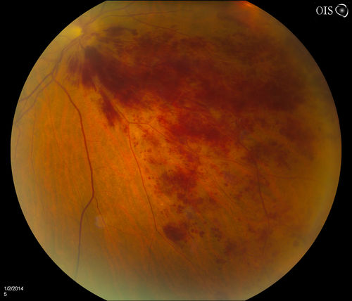 Branch Retinal Vein Occlusion
Patient's VA was 20/40, right eye. Fundus exam shows branch retinal vein occlusion nasally to the optic nerve in the right eye. 
