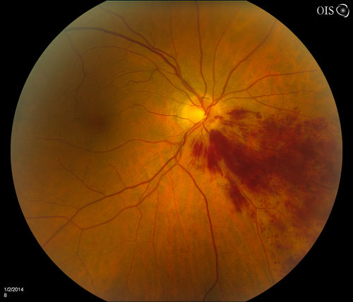 Branch Retinal Vein Occlusion
Patient's VA was 20/40, right eye. Fundus exam shows branch retinal vein occlusion nasally to the optic nerve in the right eye. 

