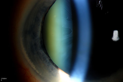 Pseudoexfoliation with Cortical Cataract Changes
Patient comes in for eval on cataract surgery for the right eye. Slit lamp exam shows pseudoexfoliation (XFS) scattered on the lens in the right eye. Patient will be followed for glaucoma suspect and to schedule cataract surgery in the future... 
