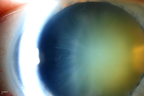 Pseudoexfoliation with Cortical Cataract Changes
Patient comes in for eval on cataract surgery for the right eye. Slit lamp exam shows pseudoexfoliation (XFS) scattered on the lens in the right eye. Patient will be followed for glaucoma suspect and to schedule cataract surgery in the future... 
