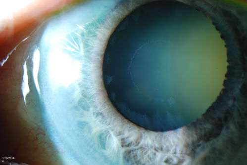 Glaucoma, Pseudoexfoliation Ring
Slit Lamp photography shows prominent pseudoexfoliation ring on the lens of the left eye. Patient will be followed up in 6-months...

